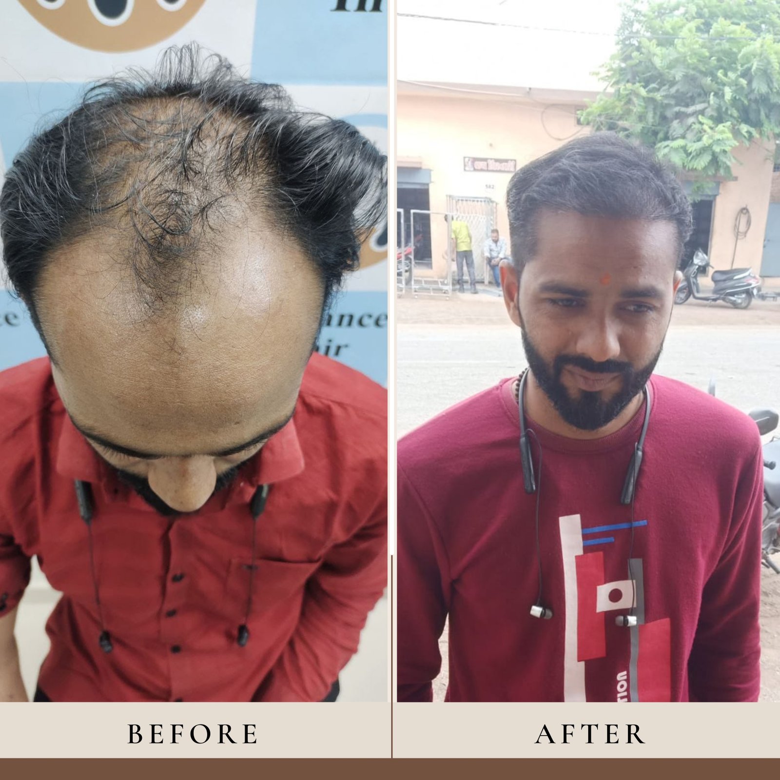 Hair Transplant Result